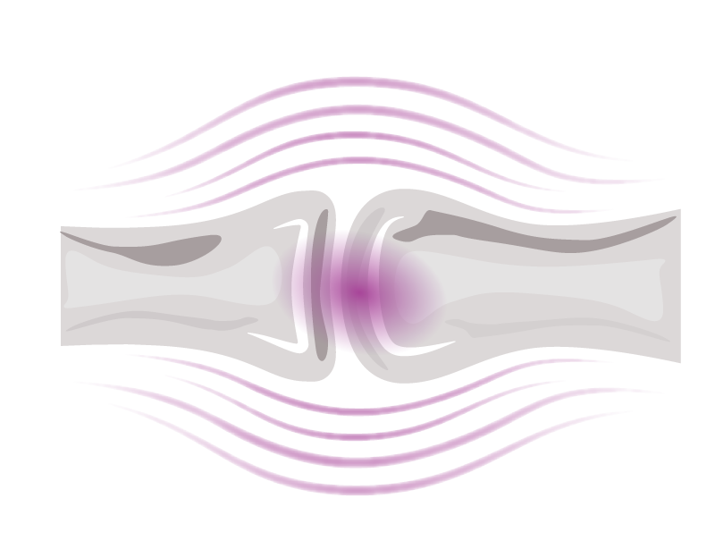 Rheumatoid arthritis
