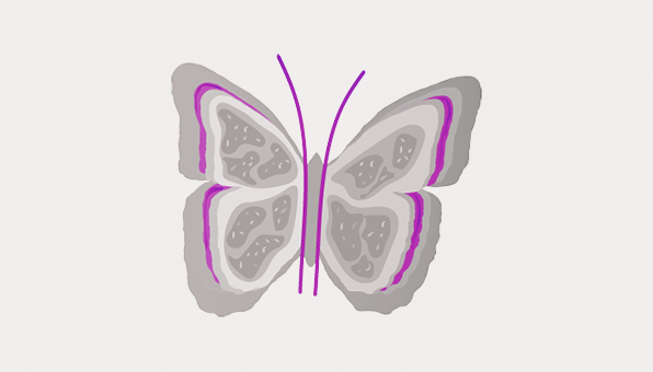 BMS Systemic Lupus